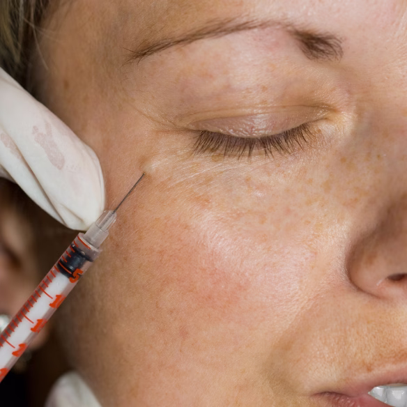 Autotest arrugas dinámicas vs estáticas candidatas Botox