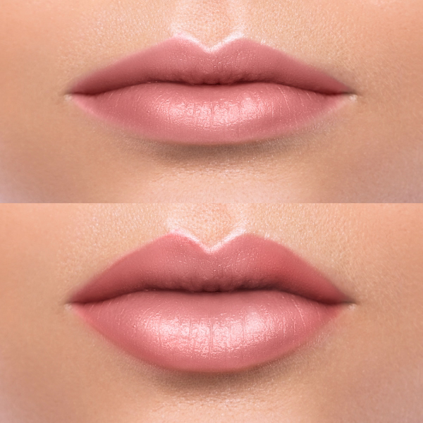 Autotest tipos de labios ideal para relleno Juvederm Restylane