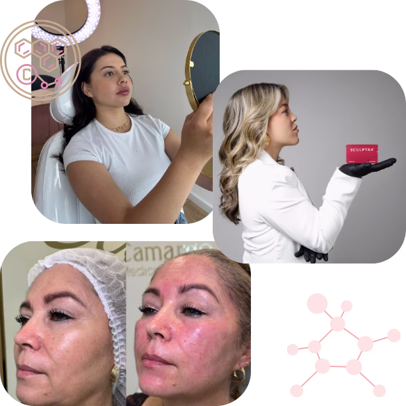 Bioestimuladores de colágeno Sculptra Radiesse HArmonyCa en Bogotá - Dra. Steffanny Camargo