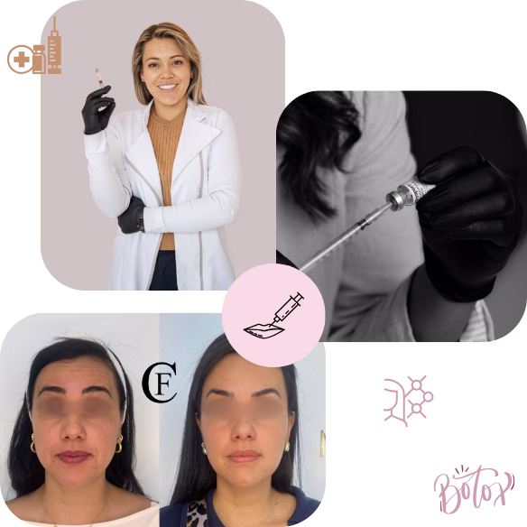 Botox toxina botulínica arrugas expresión Bogotá - Dra. Stefany Camargo