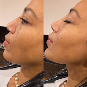 Armonización facial completa equilibrio natural antes después