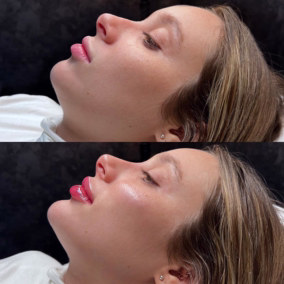 Antes y después relleno labios Juvederm Ultra natural Bogotá resultado 6 meses
