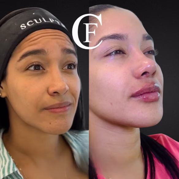 Autotest arrugas dinámicas vs estáticas candidatas Botox®