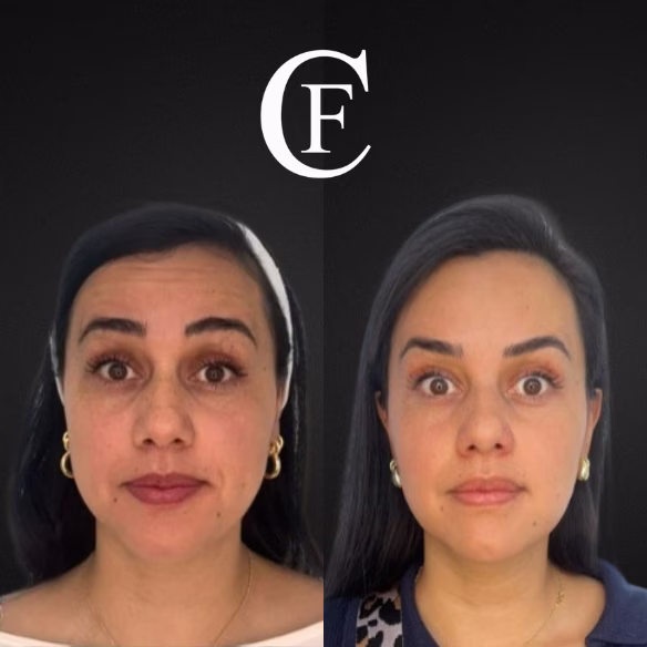Doctora Steffanny Camargo mostrando el producto para la aplicación botox tercio superior facial