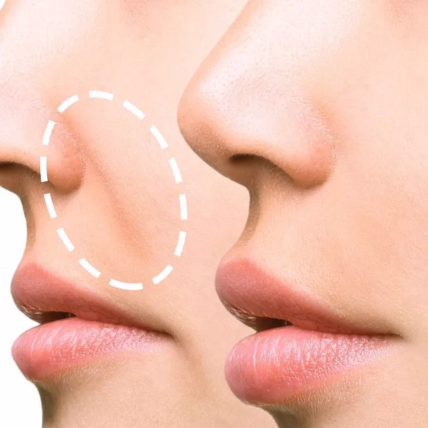 Comparación resultado natural vs artificial surcos nasogenianos técnica médica
