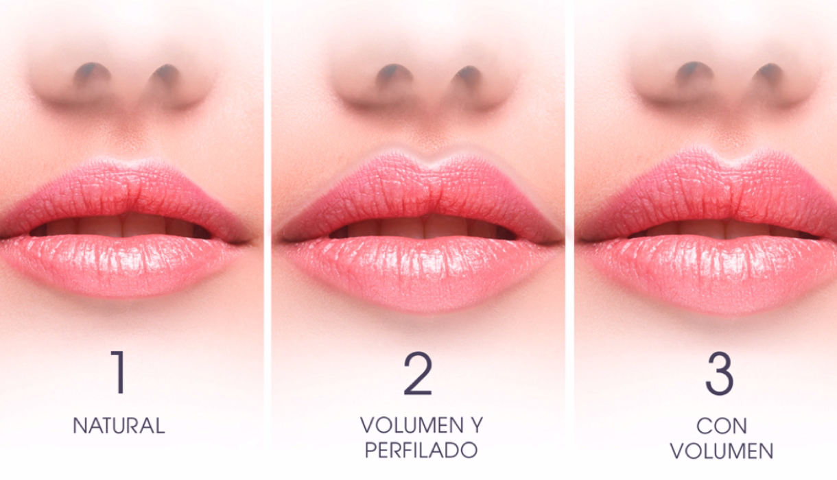 Técnicas Russian Lips vs Enhancement natural paso a paso puntos infiltración