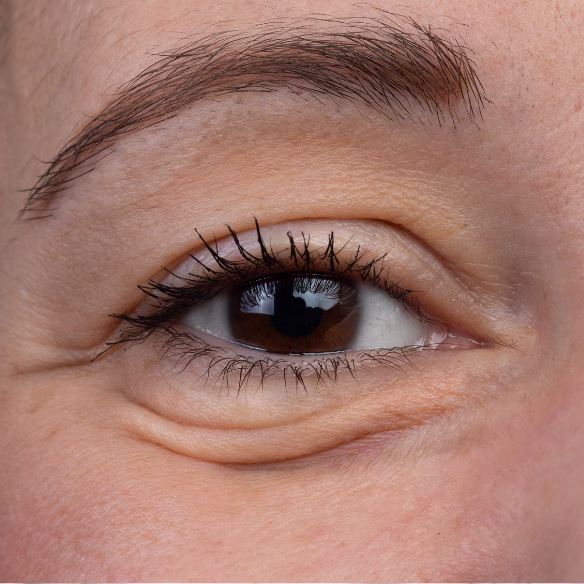 Tipos de ojeras clasificación según causa y tratamiento específico