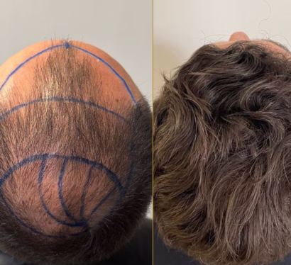 Bioestimuladores Sculptra Radiesse doctora Steffanny Camargo